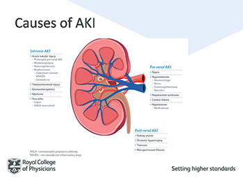 Acute Kidney Injury and Intravenous Fluid Therapy