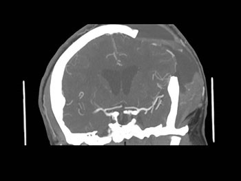 Neurologic Emergencies