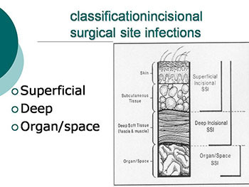 What is new in management of Surgical Infection