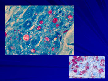 Mycobacterium leprae