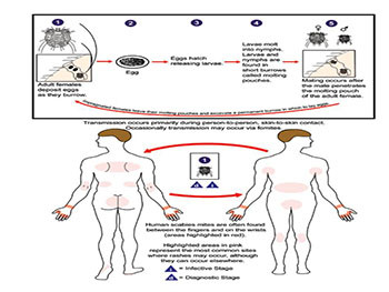 Scabies Epidemiology Clinical Manifestation and Treatment