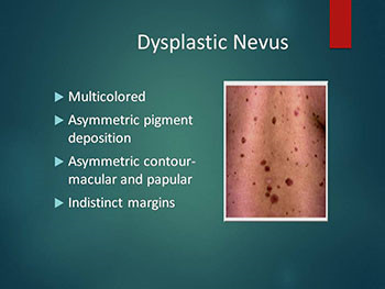 Disorders of Melanocytes Melanoma