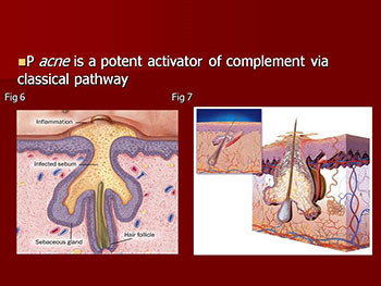 Acne and Acne related disorders