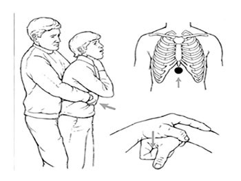 Basic Airway Management