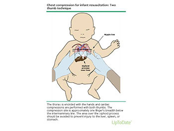 Neonatal resuscitation-NNR