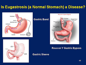 Obesity Dyslipidemia And The Metabolic Syndrome