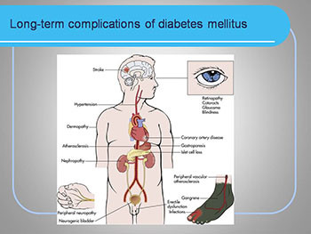 Long-Term Complications of Diabetes Mellitus