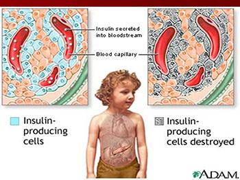 Diabetes Mellitus In Children
