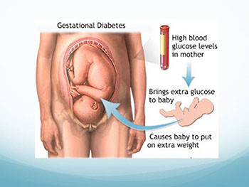 Gestational Diabetes Mellitus Stake
