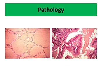 Thyrotoxicosis