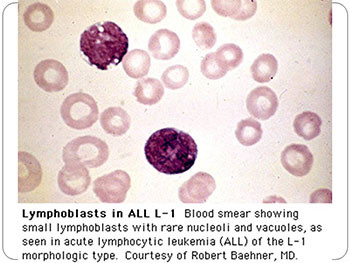 Acute Leukemia