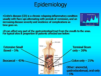 Gastroenterology-Crohns Disease