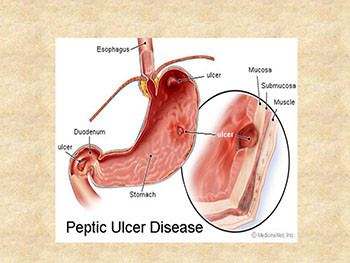 Peptic Ulcer Disease