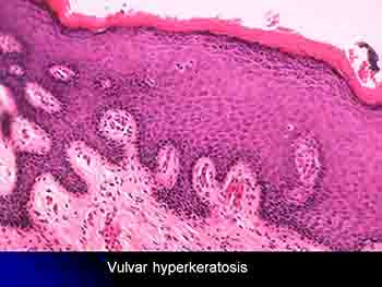 Pre-cancer and Malignant Disease of Vulva
