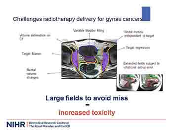 Radiotherapy Research in Gynaecological Cancers