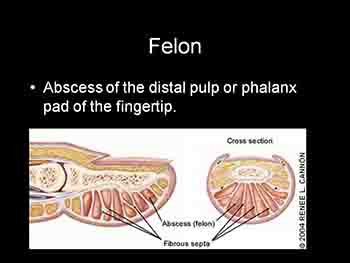 Hand Infections