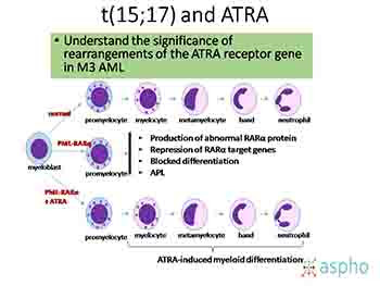 Acute and Chronic Myeloid Leukemia