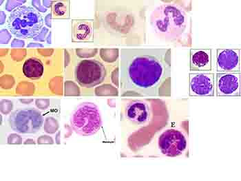 RBC and Bleeding Disorders