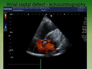 Congenital Heart Diseases