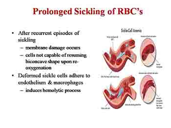 Sickle Cell Disease-Epidemiology Genetics Pathophysiology