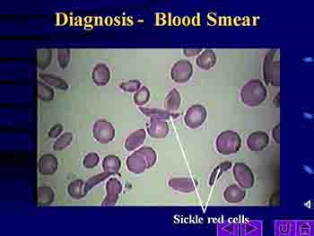 What is Sickle Cell Disease