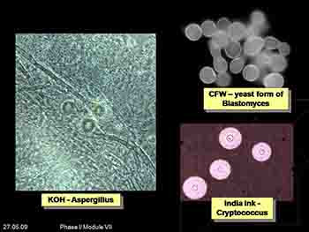 Laboratory Diagnosis of Fungal Infections