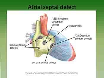 Congenital Heart Diseases