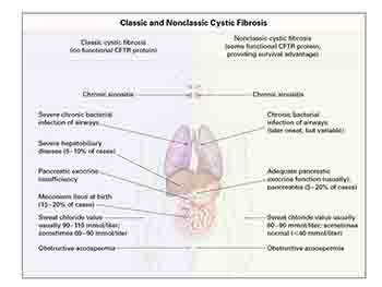 Cystic Fibrosis