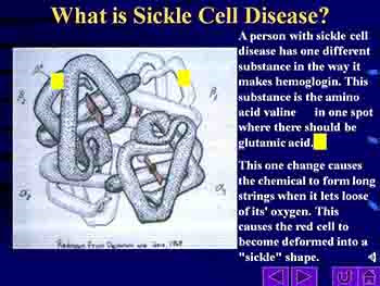 What Is Sickle Cell Disease