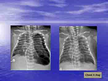 Respiratory Distress In Newborn