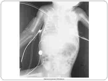 Idiopathic-Infant Respiratory Distress Syndrome