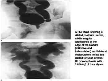 Urinary Tract Infection In Children