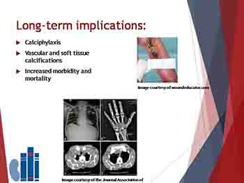 Bone Mineral Disorder-Calcium Vitamin D and Phosphorus