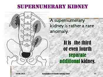 Anomalies of Genito-Urinary Tract