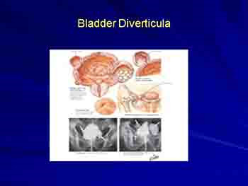 Urinary Bladder-Congenital Anomalies