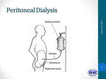 Hemodialysis And Peritoneal Dialysis