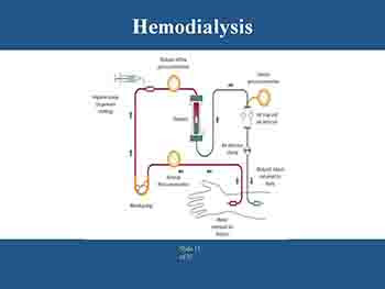 The Transition From Chronic Kidney Disease-CKD To Kidney Failure