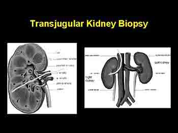 Hepatorenal Syndrome-Pathophysiologic Basis of Therapy And Current Management