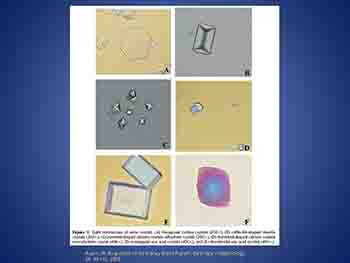 Kidney Stones in Children