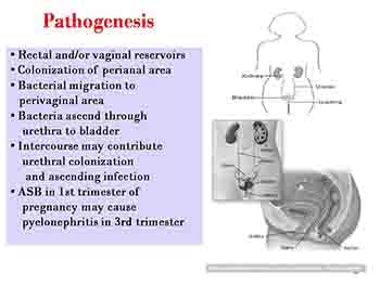 Pyelonephritis