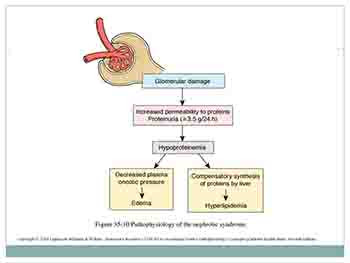 Nephrotic Syndrome