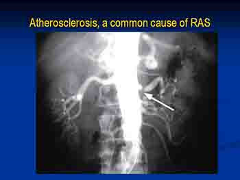 Renal Artery Stenosis