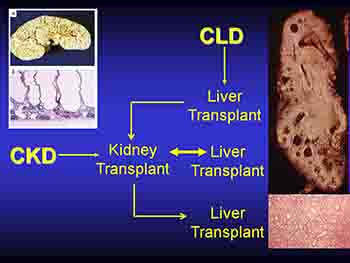 Systemic Hypertension and Renal Transplantation In Arpkd
