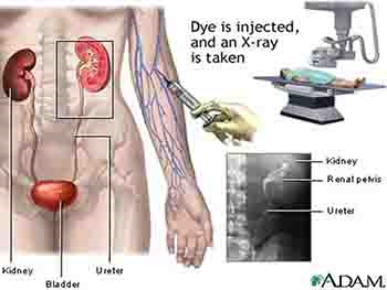 Urolithiasis