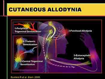 Migraine Overview