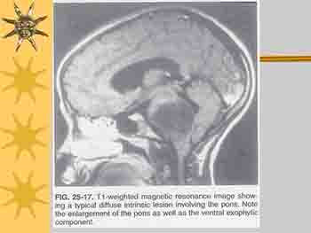 Brain Tumors In Pediatrics