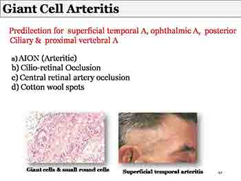 Ocular Manifestations of Systemic Diseases