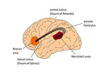 Aphasia