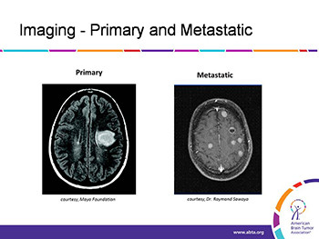 Brain Tumor