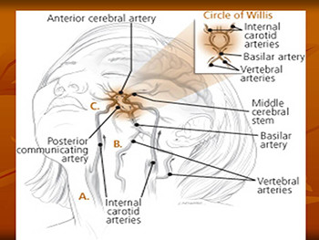 Cerebrovascular Accident